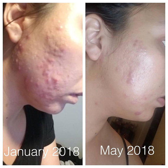 Side-by-side skin progress comparison: January shows acne, May shows clearer skin.