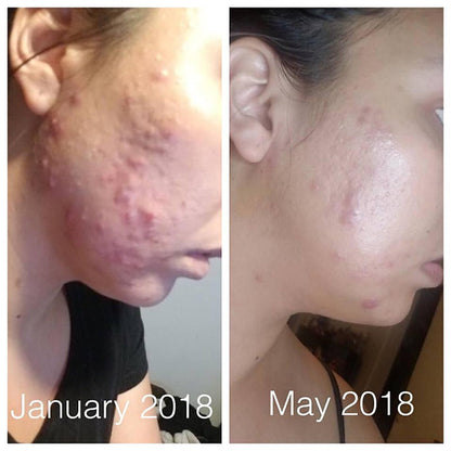 Side-by-side skin progress comparison: January shows acne, May shows clearer skin.