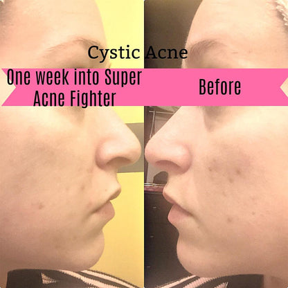 Side-by-side profile of a face showing acne improvement after one week, with pink text overlay.